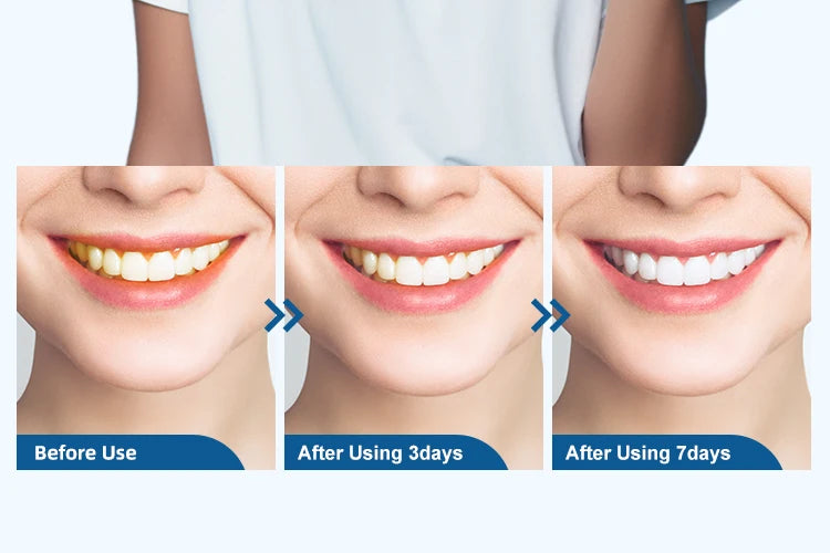 Blanqueá tu sonrisa en casa — resultados visibles desde la primera sesión